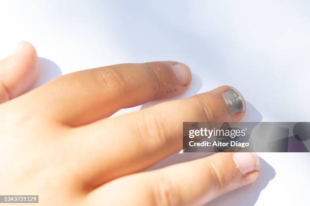 finger injured by a blow from a child. the nail has turned black. - broken finger ストックフォトと画像