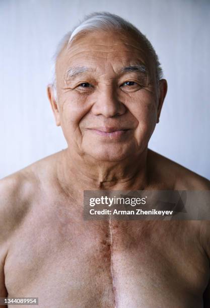 senior man with with surgical scar on his chest - heart surgery scar stock pictures, royalty-free photos & images
