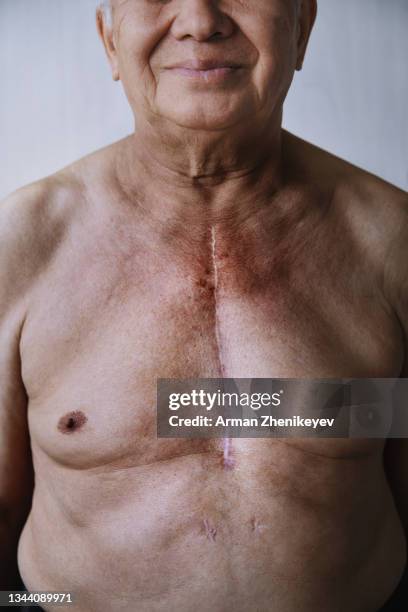 senior man with with surgical scar on his chest - heart surgery scar fotografías e imágenes de stock