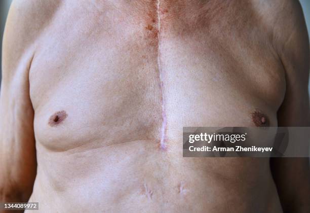 close-up view on the senior man chest with surgical scar - heart surgery scar fotografías e imágenes de stock