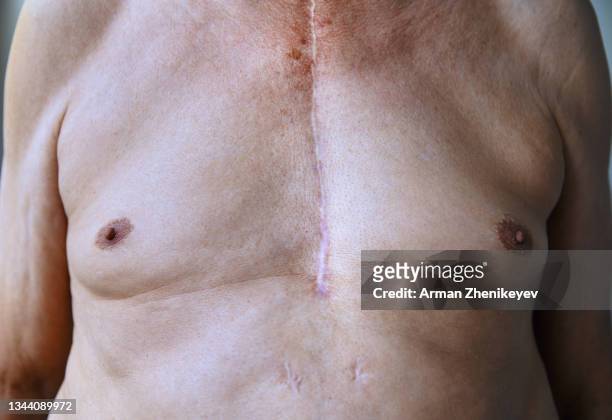 close-up view on the senior man chest with surgical scar - cicatriz imagens e fotografias de stock