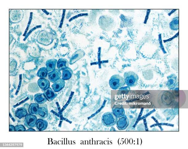 old engraved illustration of bacillus anthracis  in the blood (500 : 1) under the microscope - cutaneous anthrax photos et images de collection