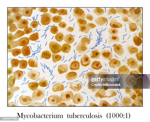old engraved illustration of mycobacterium tuberculosis in the sputum (1000 : 1) under the microscope - mycobacterium tuberculosis bacteria stockfoto's en -beelden