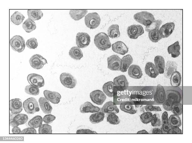 old engraved illustration of spirals of febris in the blood (750 : 1) under the microscope - yellow fever stock pictures, royalty-free photos & images