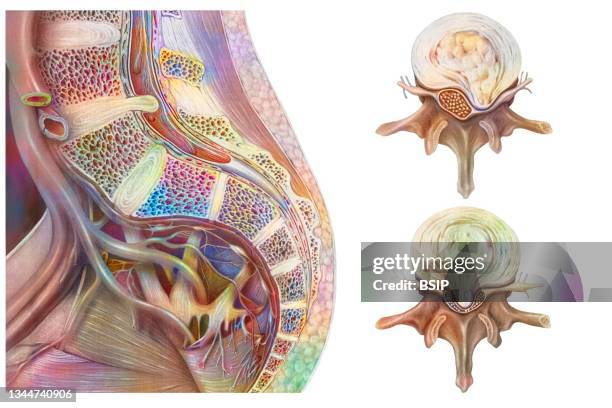 herniated disc drawing - herniated disc 幅插畫檔、美工圖案、卡通及圖標