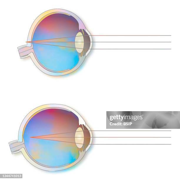 Eye Problem Graphicsgraphics Eye Trouble Drawing High-Res Vector Graphic - Getty Images