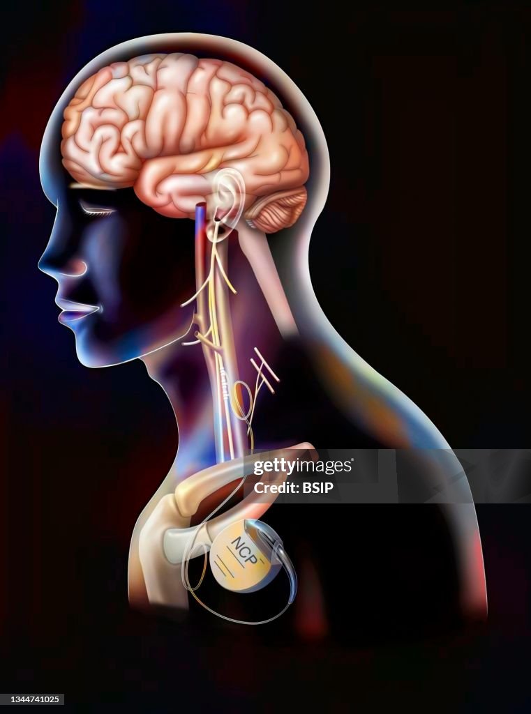 Epilepsy treatment drawing