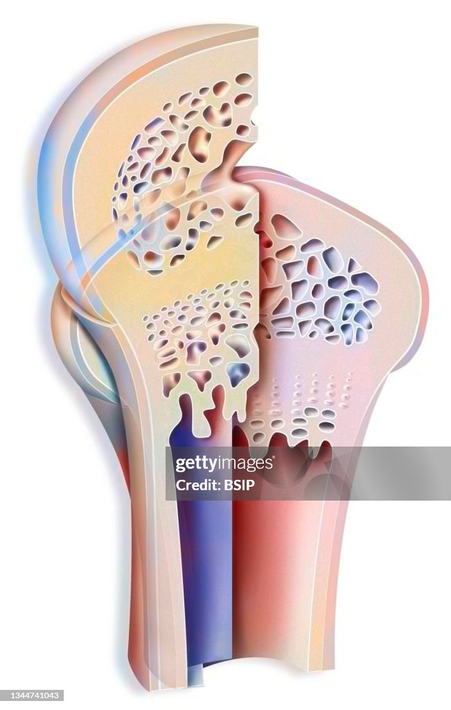 Bone growth