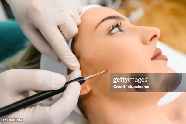 mole removal - mole stockfoto's en -beelden