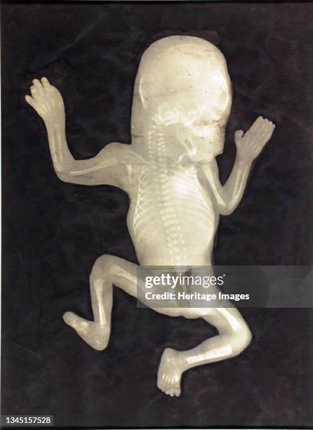 Degree of Ossification of a Five-Month-Old Fetus , 1898. Gelatin silver print with applied india ink or watercolor. Artist Unknown.