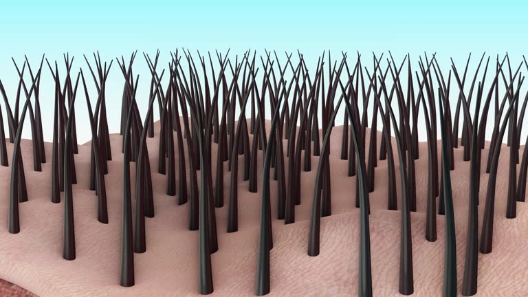 75 Hair Transplant Videos and HD Footage - Getty Images 75 Hair Transplant Videos and HD Footage - Getty Images