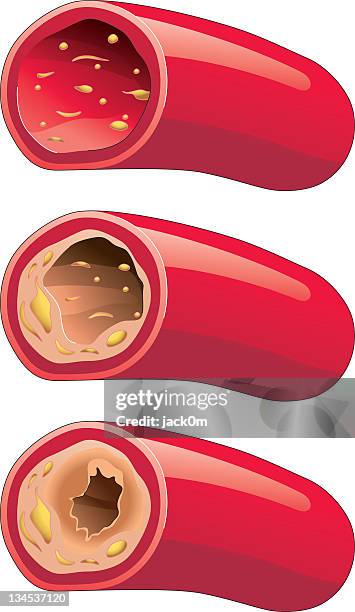 illustrazioni stock, clip art, cartoni animati e icone di tendenza di l'aterosclerosi - sclerosis