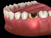 Periostitis tooth - Lump on Gum Above Tooth. Medically accurate dental 3D illustration