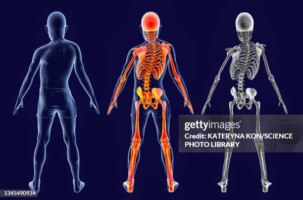 scoliosis of the spine, illustration - scoliosis stock illustrations