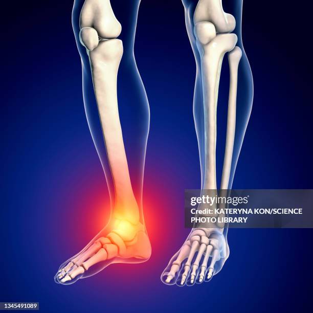 painful ankle, illustration - sehnenscheidenentzündung stock-grafiken, -clipart, -cartoons und -symbole