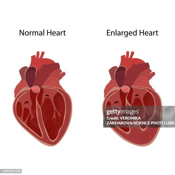normal and enlarged heart, illustration - myocardium stock-grafiken, -clipart, -cartoons und -symbole