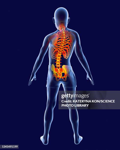 scoliosis of the spine, illustration - scoliosis stock illustrations