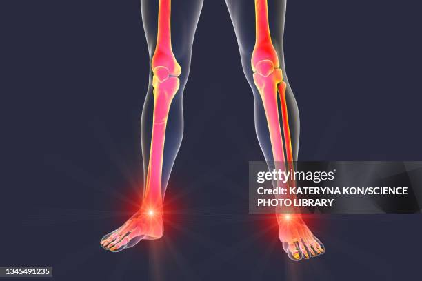 painful ankle and knee, illustration - sehnenscheidenentzündung stock-grafiken, -clipart, -cartoons und -symbole