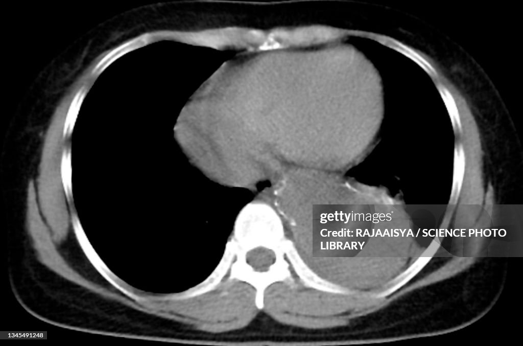 Aortic aneurysm, CT scan