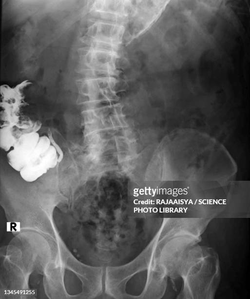 appendicography - appendix stock-fotos und bilder