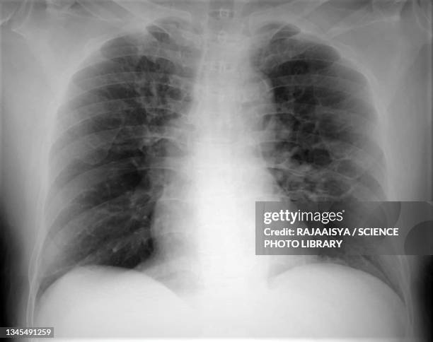 bronchiectasis, x-ray - bronchitis stock pictures, royalty-free photos & images