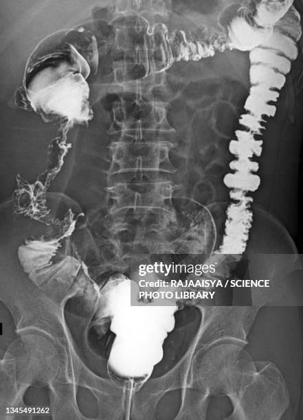 colorectal cancer, x-ray - bas stock pictures, royalty-free photos & images