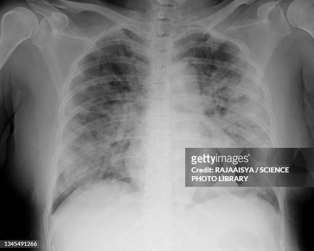 covid-19 pneumonia, x-ray - röntgen stockfoto's en -beelden
