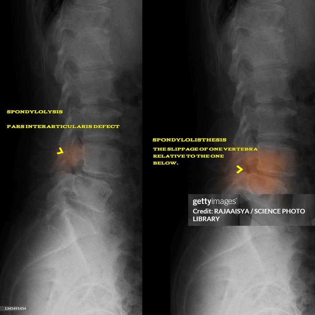 Spondylolysis and spondylolisthesis, X-rays