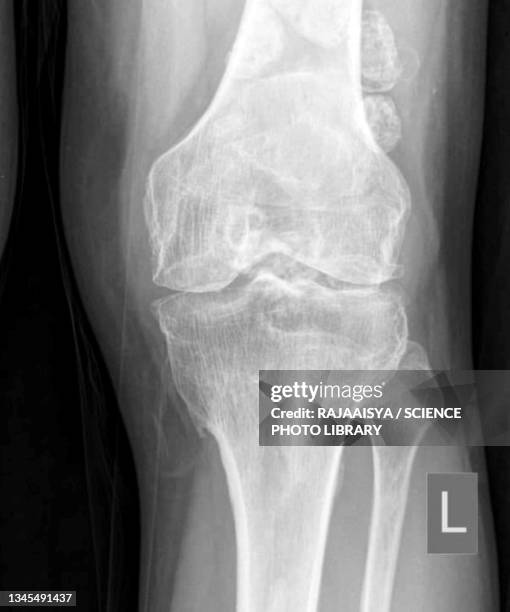 synovial chondromatosis, x-ray - synovial stock pictures, royalty-free photos & images