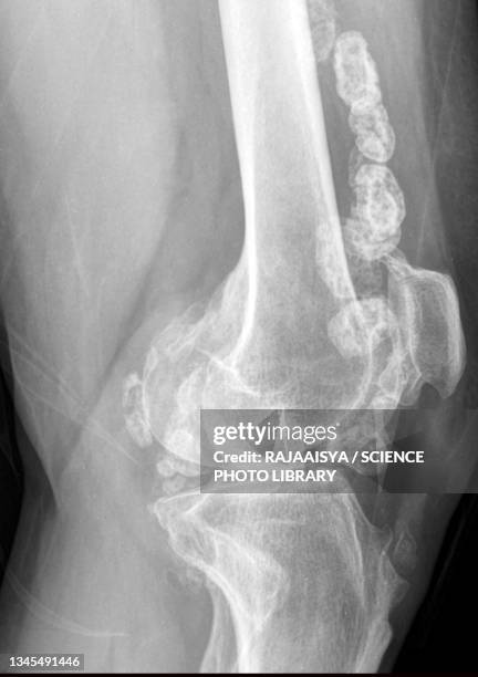 synovial chondromatosis, x-ray - synovial stock-fotos und bilder