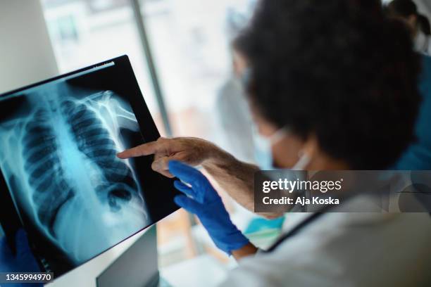 arzt analysiert ein röntgenbild eines covid-19-patienten. - menschliche lunge stock-fotos und bilder