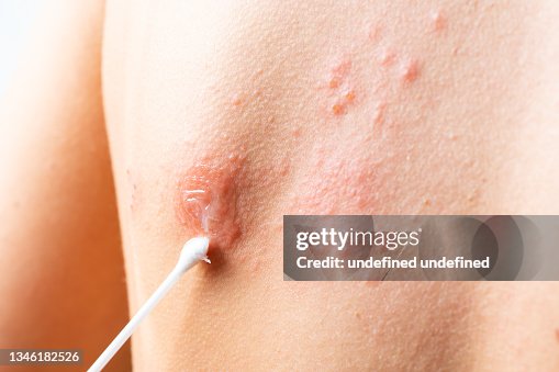 Cotton Fever Rash Cotton Swab Treatment Of Skin Rash Shingles Varicellazoster Virus Skin ...