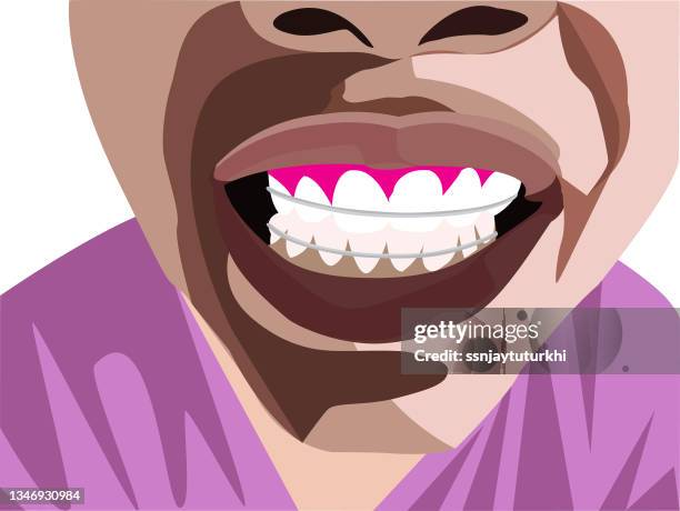 teeth braces - invisalign stock illustrations