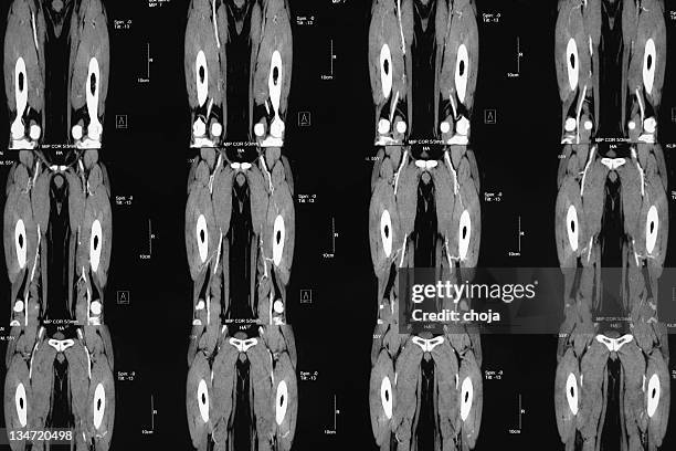 ct angiography of lower limb...peripheral artery occlusive disease - peripheral artery stock pictures, royalty-free photos & images