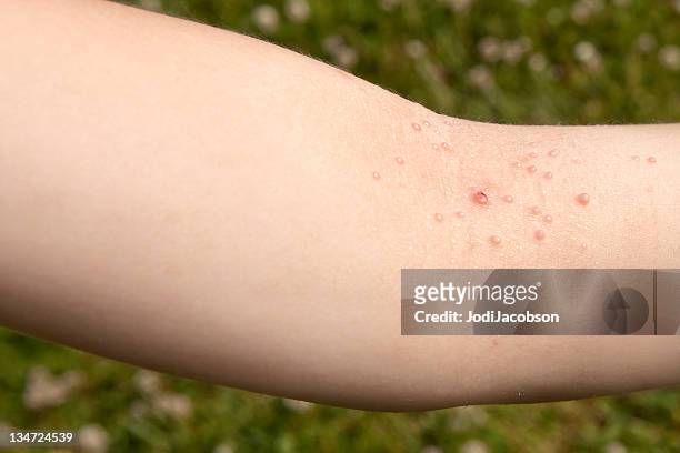 molluscum contagiosum (mc) - warts stock pictures, royalty-free photos & images