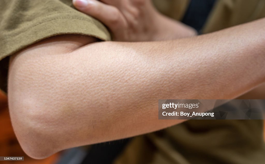 Close up of woman arm with goosebumps on her skin.