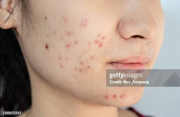 cropped shot of woman having problems of acne inflamed on her face. - oily skin stock pictures, royalty-free photos & images