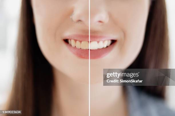 denti da donna prima e dopo lo sbiancamento - sbiancamento dentale foto e immagini stock