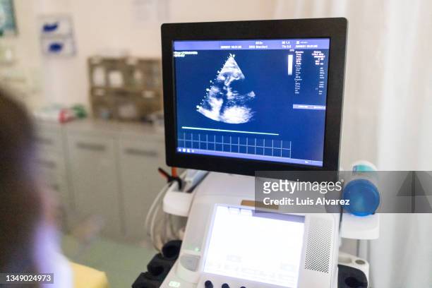 ultrasound echocardiogram computer monitor in heart clinic - pulse trace stockfoto's en -beelden