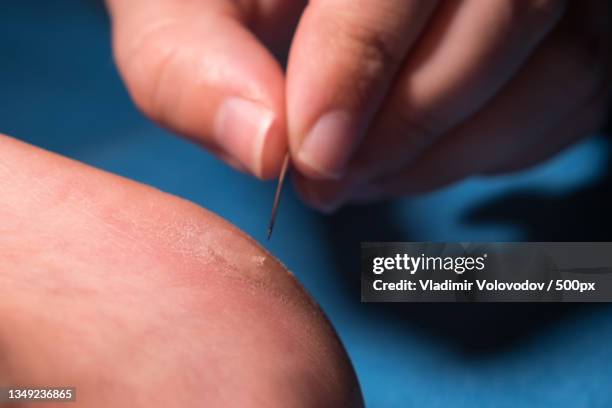 womens fingers with a needle pierce a callus on the heel - blister stockfoto's en -beelden