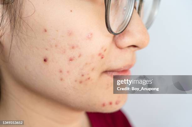 cropped shot of woman having problems of acne inflamed on her cheek. - blackheads photos et images de collection