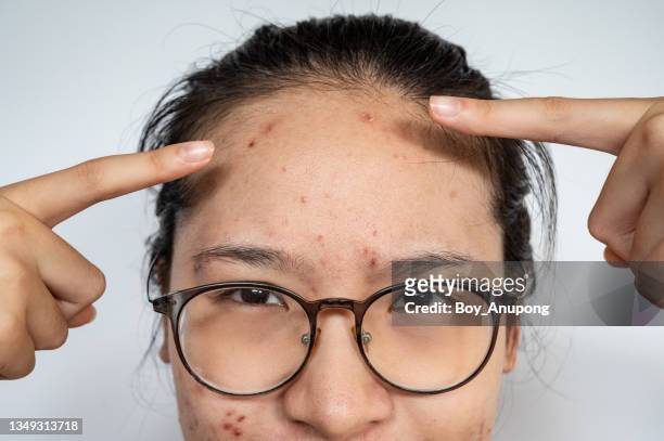 asian woman pointing to acne inflamed on her forehead. - oily skin stock pictures, royalty-free photos & images