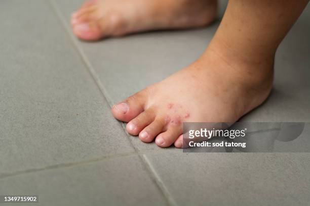 young woman the itch on her feet w/ redness rash. cause of itchy skin include athlete's foot (fungal infection), dermatitis (eczema), psoriasis, or bug bites. health care. copy space. - eczema child stock-fotos und bilder