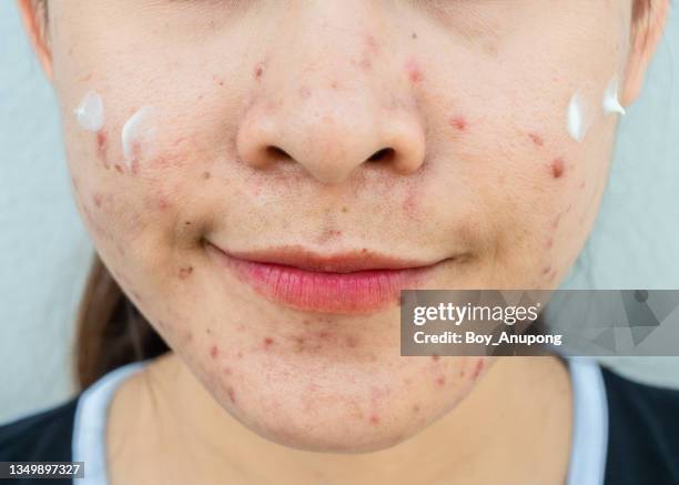 cropped shot of asian woman after applying acne cream on her face for solving acne inflammation. - blackheads photos et images de collection