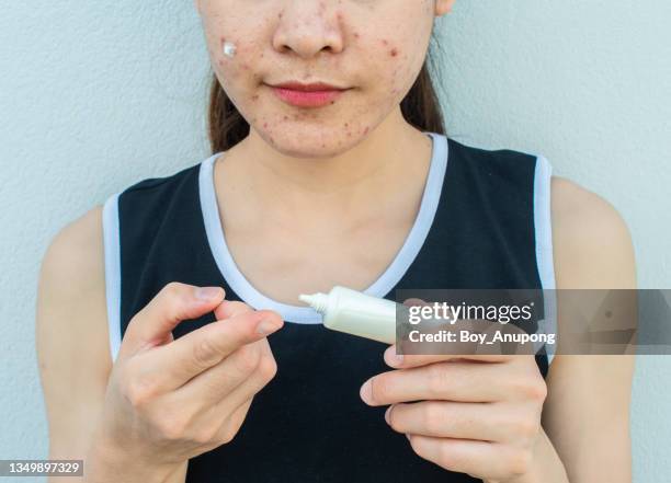 cropped shot of asian woman squeezing acne cream from tube for applying cream on her face for solving acne inflammation. - oily skin stock pictures, royalty-free photos & images