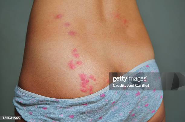 bedbug bites - bed bug stock pictures, royalty-free photos & images