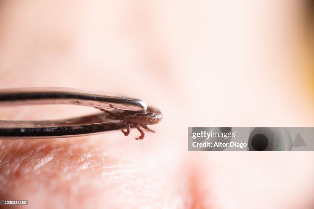 Tweezers holding a tick on a person's skin. Germany