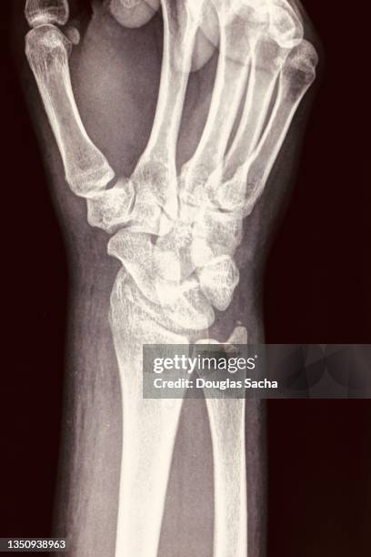 arm, wrist, and hand, x-ray image on black background - hand bones stock pictures, royalty-free photos & images