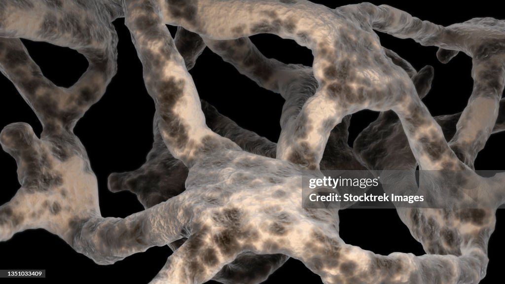 Bone Structure Of Osteoporosis High Biology Diagrams