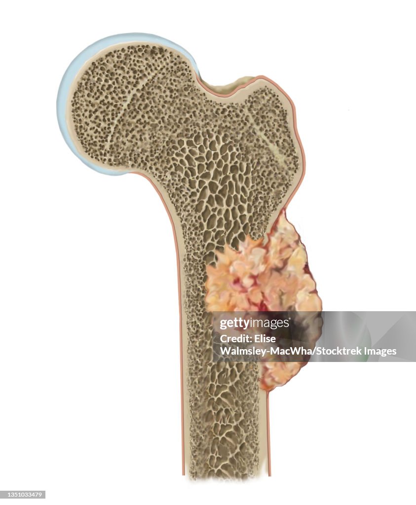 Detail of osteosarcoma on femur.